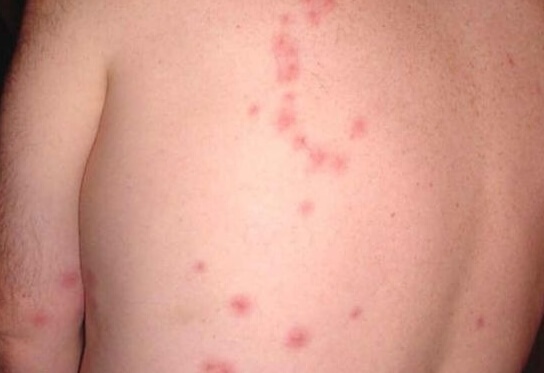 Фото: как выглядит укус клопа на теле человека, симптомы укусов